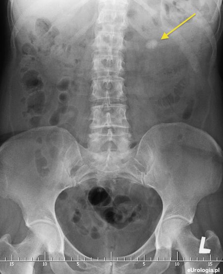 Kamień 1 cm w miedniczce lewej nerki