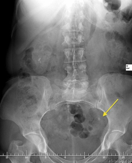 Kamień w moczowodzie - RTG