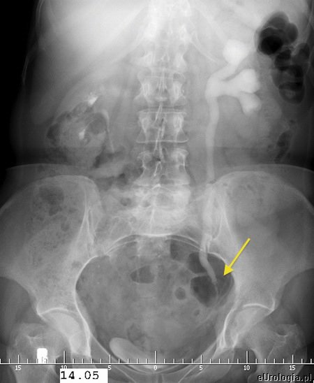 Kamień w moczowodzie - urografia