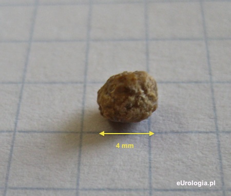 Zł&oacute;g 4 mm - kamica moczowodowa