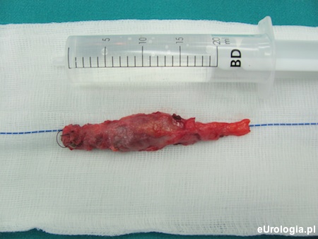 Kamica kikutu moczowodu - preparat