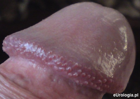 Grudki perliste korony żołędzi