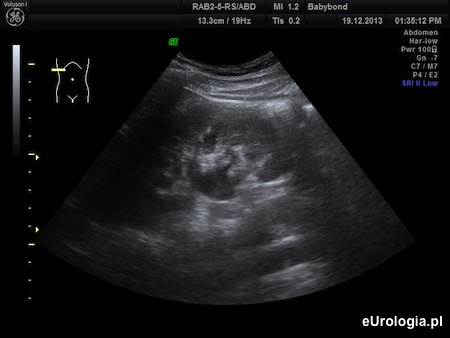 Poszerzenie UKM - b&oacute;l okolicy lędźwiowej i krwiomocz