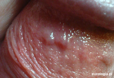 Pęcherzyki na napletku