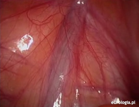 Laparoskopowa operacja usunięcia żylak&oacute;w powr&oacute;zka nasiennego