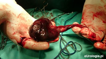 Martwe jądro usunięte z powodu skrętu powr&oacute;zka.