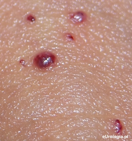 Naczyniak sk&oacute;ra penisa