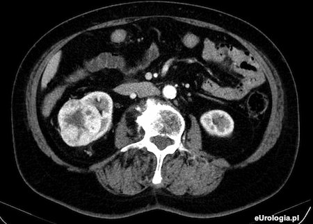 Guz prawej nerki - przygotowanie do nefrektomii
