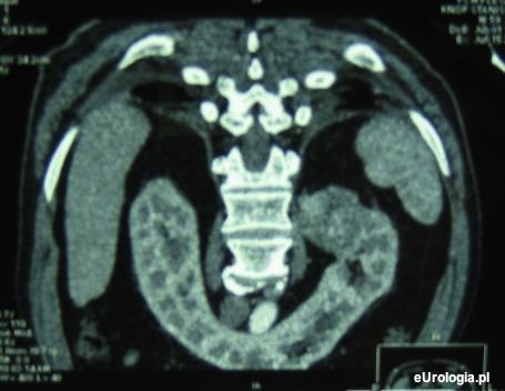 Nerka podkowiasta - Eurologia.pl