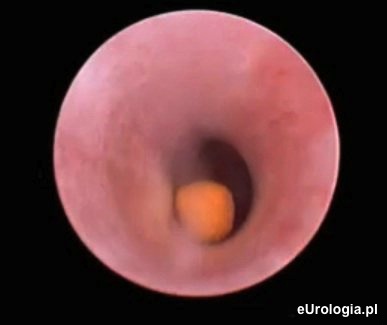 Kamica moczanowa - zł&oacute;g w moczowodzie