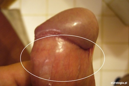 Obrzęk penisa 
