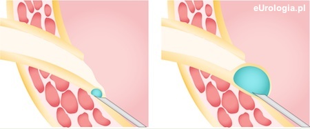Ostrzykiwanie ujścia moczowodu Defluksem