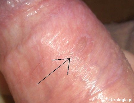 Owrzodzenie napletka