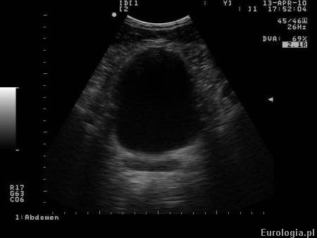 USG z pełnym pęcherzem