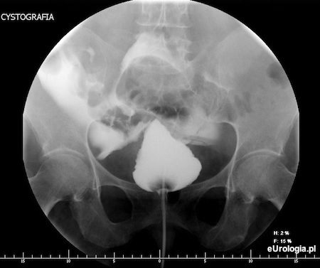 Perforacja pęcherza moczowego - obraz w cystografii