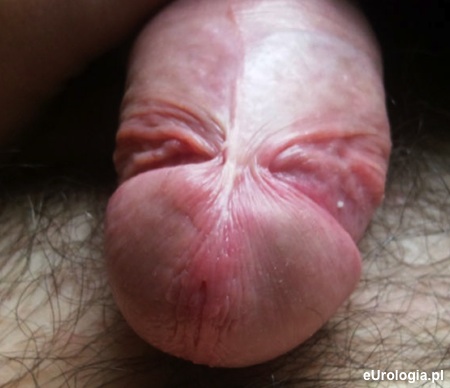 Kr&oacute;tkie wędzidełko