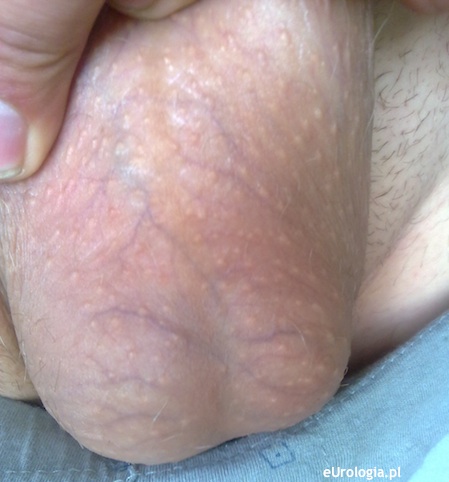 Poszerzone żylaki na mosznie