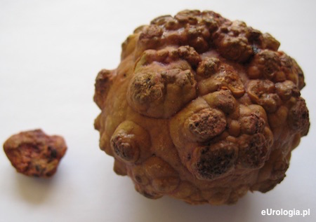 Kamica pęcherza - powikłanie BPH