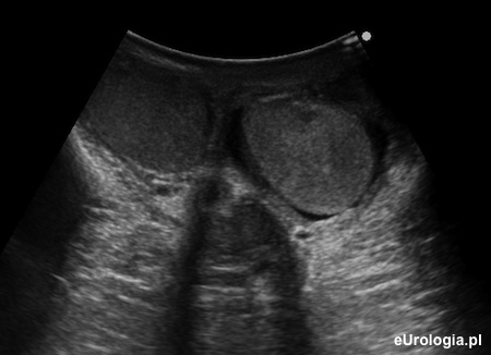 Obraz ultrasonograficzny jąder