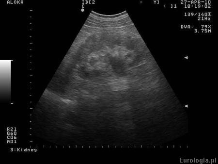 USG prenatalne - wodonercze