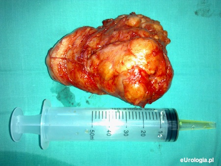 Prostata o objętości 200 ml.