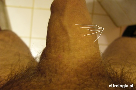 Przebarwienia na penisie