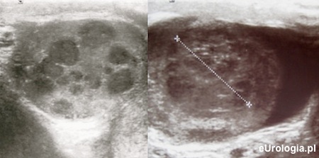 USG - diagnostyka obrazowa raka jądra