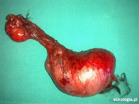 Usunięte jądro wraz z powr&oacute;zkiem nasiennym