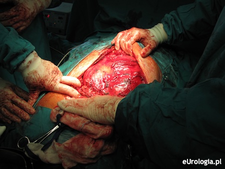 Rak nerki - otyłość jako czynnik ryzyka.