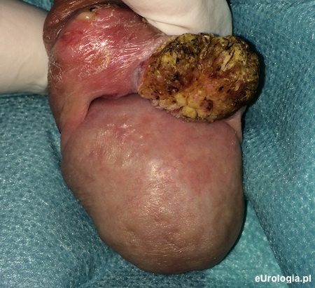 Rak prącia - Ca planoepitheliale keratodes