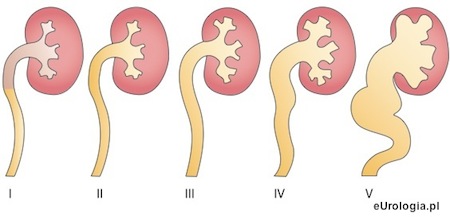 Diagnostyka refluksu - stopnie odpływu moczu