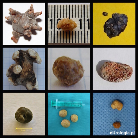 Rodzaje kamicy nerkowej - skład złogu