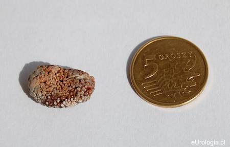 Skład złog&oacute;w nerkowych - analiza