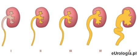 Stopnie odpływu pęcherzowo - moczowodowego