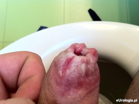 Stulejka zapalna u pacjenta z cukrzycą