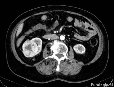 Tomografia - guz prawej nerki