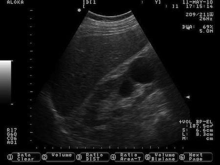 Torbiel dolnego bieguna nerki prawej