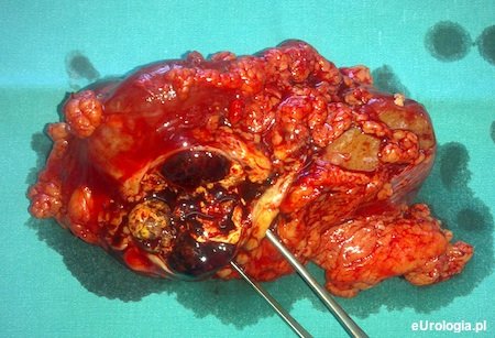 Torbiel nerki 4 kategorii według klasyfikacji Bosniaka.