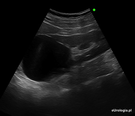 Torbiel g&oacute;rnego bieguna nerki lewej - USG