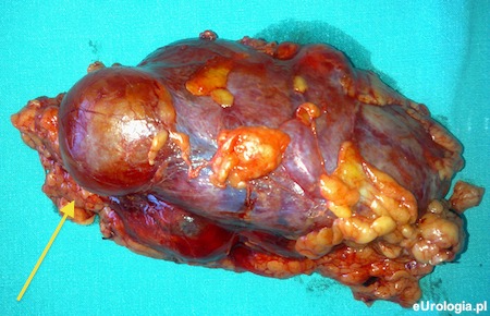 Torbiel prosta nerki średnicy 4 cm.