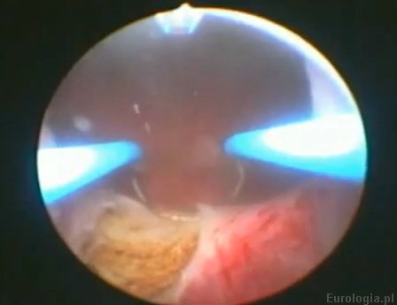 TURP - przezcewkowa resekcja prostaty