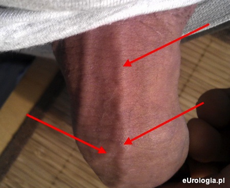 Twarda żyła na penisie