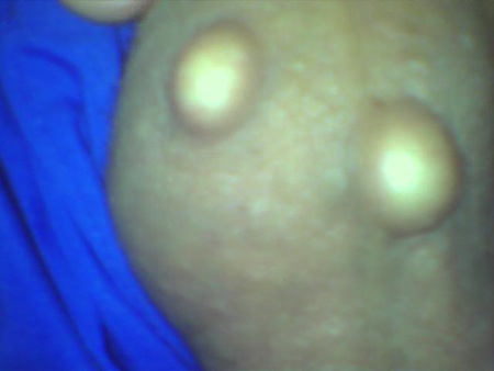 Kaszak moszny - twardy, biały guzek moszny.