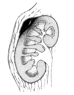 1 stopień uszkodzenia nerki