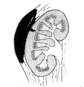 2 stopień uszkodzenia nerki