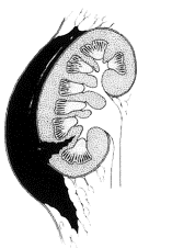 3 stopień uszkodzenia nerki