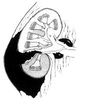 Uraz nerki IV stopień