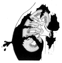 Uraz nerki V stopień