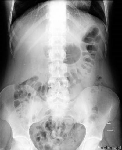 Urografia - zdjęcie przeglądowe nerek i pęcherza