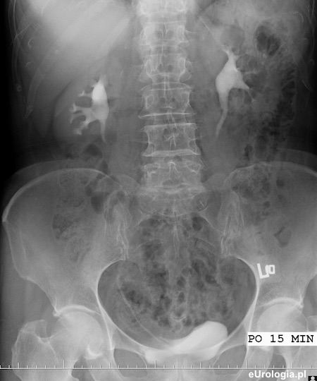 Kamica nerkowa - obraz urograficzny